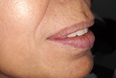 dental implant Mobile Prosthesis