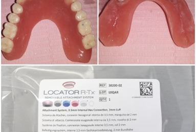 dental implant Mobile Prosthesis