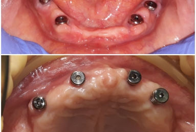 dental implant Mobile Prosthesis