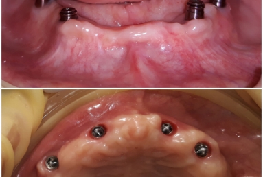 dental implant Mobile Prosthesis