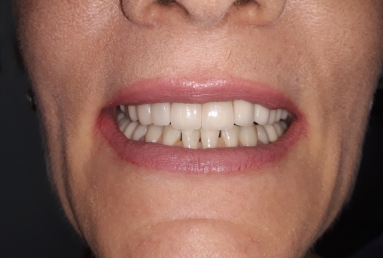 surgical treatment dental implants, ceramic crowns