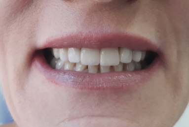 surgical treatment dental implants, ceramic crowns