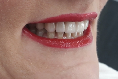 surgical treatment dental implants, ceramic crowns