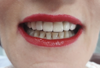 surgical treatment dental implants, ceramic crowns