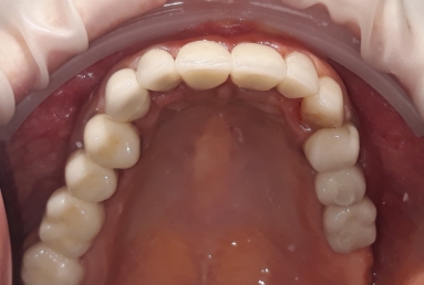 surgical treatment dental implants, ceramic crowns