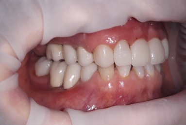 surgical treatment dental implants, ceramic crowns