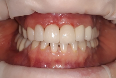 surgical treatment dental implants, ceramic crowns