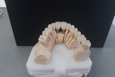 surgical treatment dental implants, ceramic crowns