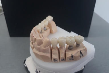 surgical treatment dental implants, ceramic crowns