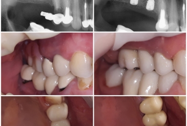 surgical treatment dental implants, ceramic crowns