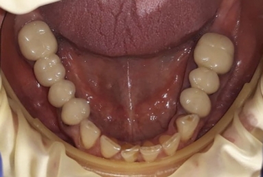 surgical treatment dental implants, ceramic crowns