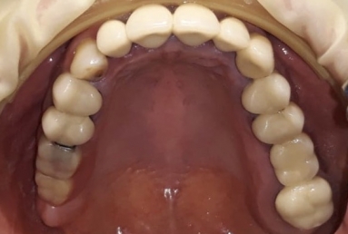 surgical treatment dental implants, ceramic crowns