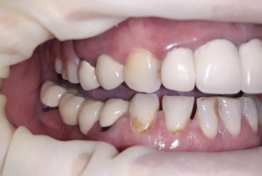 surgical treatment dental implants, ceramic crowns