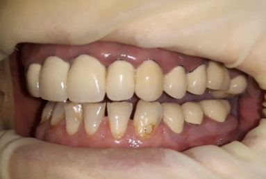 surgical treatment dental implants, ceramic crowns