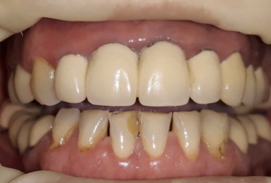 surgical treatment dental implants, ceramic crowns