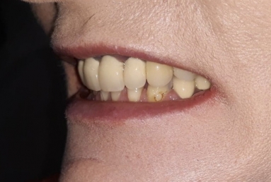 surgical treatment dental implants, ceramic crowns