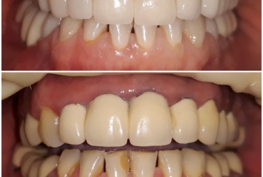 surgical treatment dental implants, ceramic crowns