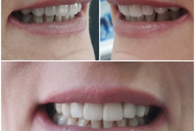 surgical treatment dental implants, ceramic crowns