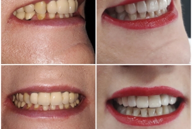 surgical treatment dental implants, ceramic crowns