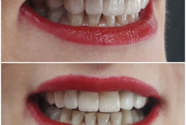 surgical treatment dental implants, ceramic crowns
