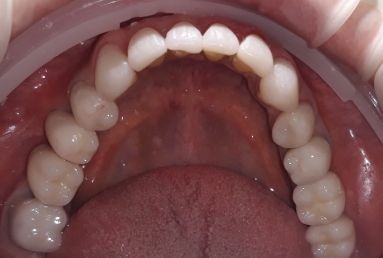 ceramic veneers on the lower frontal teeth