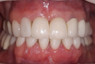 ceramic veneers on the lower frontal teeth