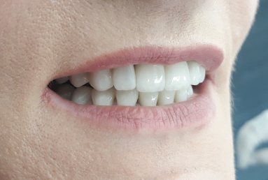 ceramic veneers on the lower frontal teeth