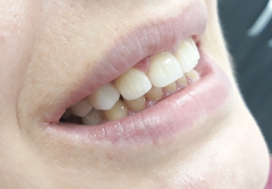 Lateral incisors anodontia