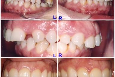 Lateral incisors anodontia - dental implants , sinsus lift