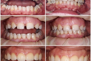 Lateral incisors anodontia - dental implants , sinsus lift