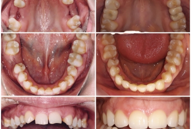 Lateral incisors anodontia - dental implants , sinsus lift