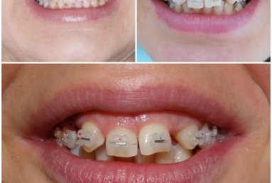 Lateral incisors anodontia - dental implants , sinsus lift