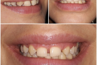 Lateral incisors anodontia - dental implants , sinsus lift
