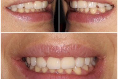 Lateral incisors anodontia - dental implants , sinsus lift