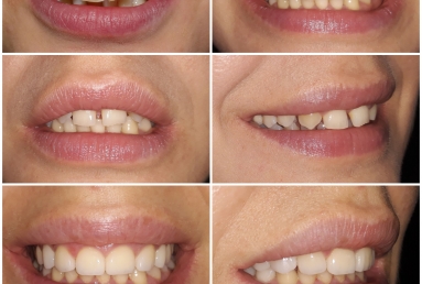 Lateral incisors anodontia - dental implants , sinsus lift