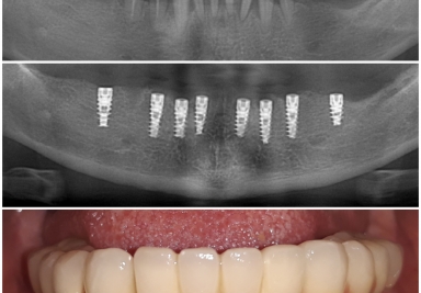 Full arch fix restoration on Alpha Bio implants