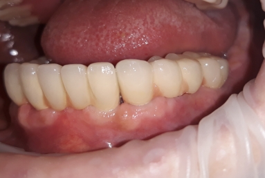 Alpha Bio Nobel implants