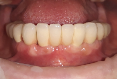 Alpha Bio Nobel implants