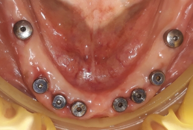 Alpha Bio Nobel implants