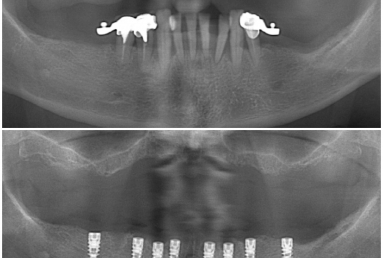 Alpha Bio Nobel implants