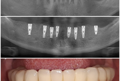 Alpha Bio Nobel implants