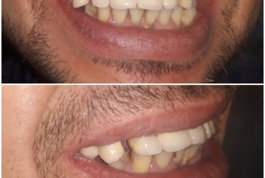 Full mouth rehabilitation with dental implants and fixed ceramic crowns