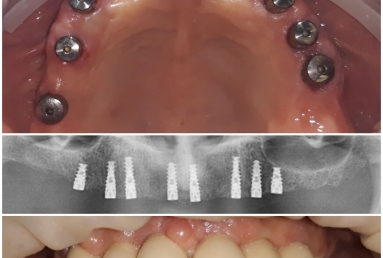 Full mouth rehabilitation with dental implants and fixed ceramic crowns