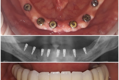 Full mouth rehabilitation with dental implants and fixed ceramic crowns