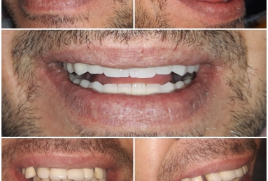Full mouth rehabilitation with dental implants and fixed ceramic crowns