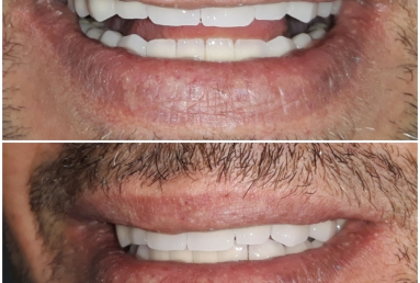 Full mouth rehabilitation with dental implants and fixed ceramic crowns