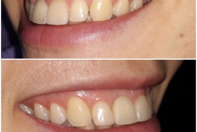 Megagen Anyridge dental implant