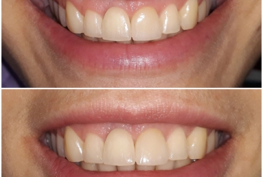 Megagen Anyridge dental implant