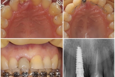 Megagen Anyridge dental implant
