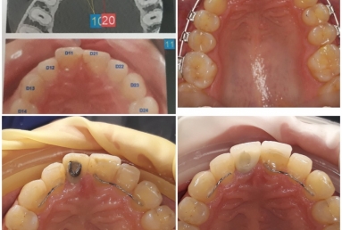 Megagen Anyridge dental implant